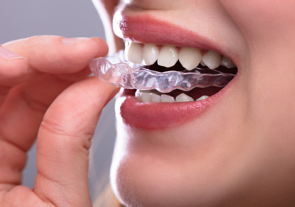 Straighten your teeth with ClearCorrect aligners Thibodaux, Louisiana